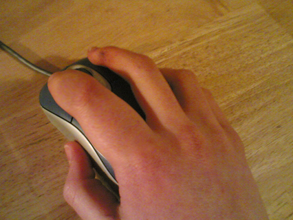 A hand with a swollen index finger due to over-exercise